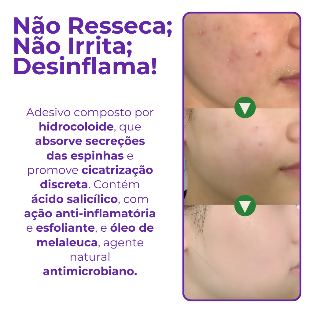 Anti-Acne Patch - Eliminate Pimples without Marks in 1 Day!