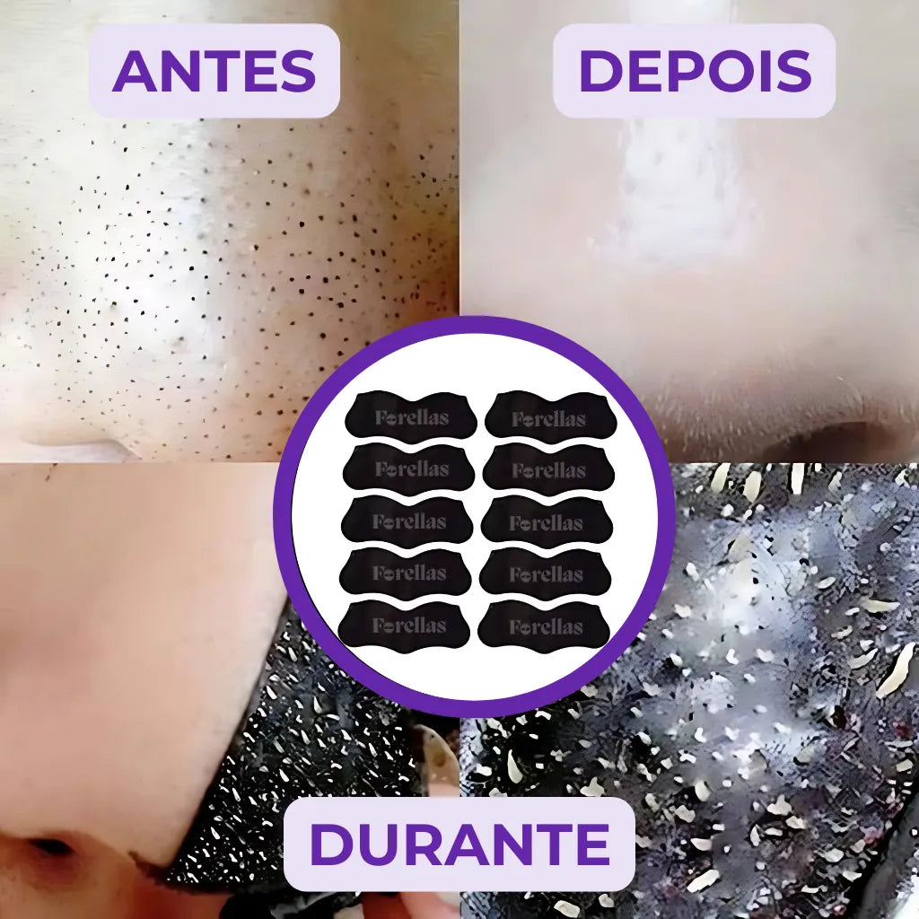 Blackhead Mask - Eliminate Blackheads from Your Nose Painlessly! 