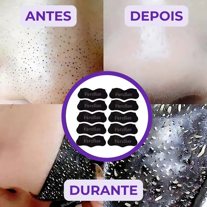 Blackhead Mask - Eliminate Blackheads from Your Nose Painlessly! 