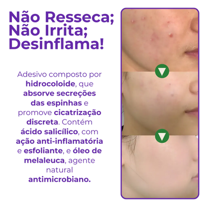 Anti-Acne Patch - Eliminate Pimples without Marks in 1 Day! 