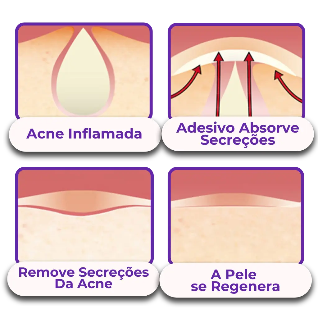 Anti-Acne Patch - Eliminate Pimples without Marks in 1 Day! 