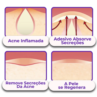 Anti-Acne Patch - Eliminate Pimples without Marks in 1 Day! 