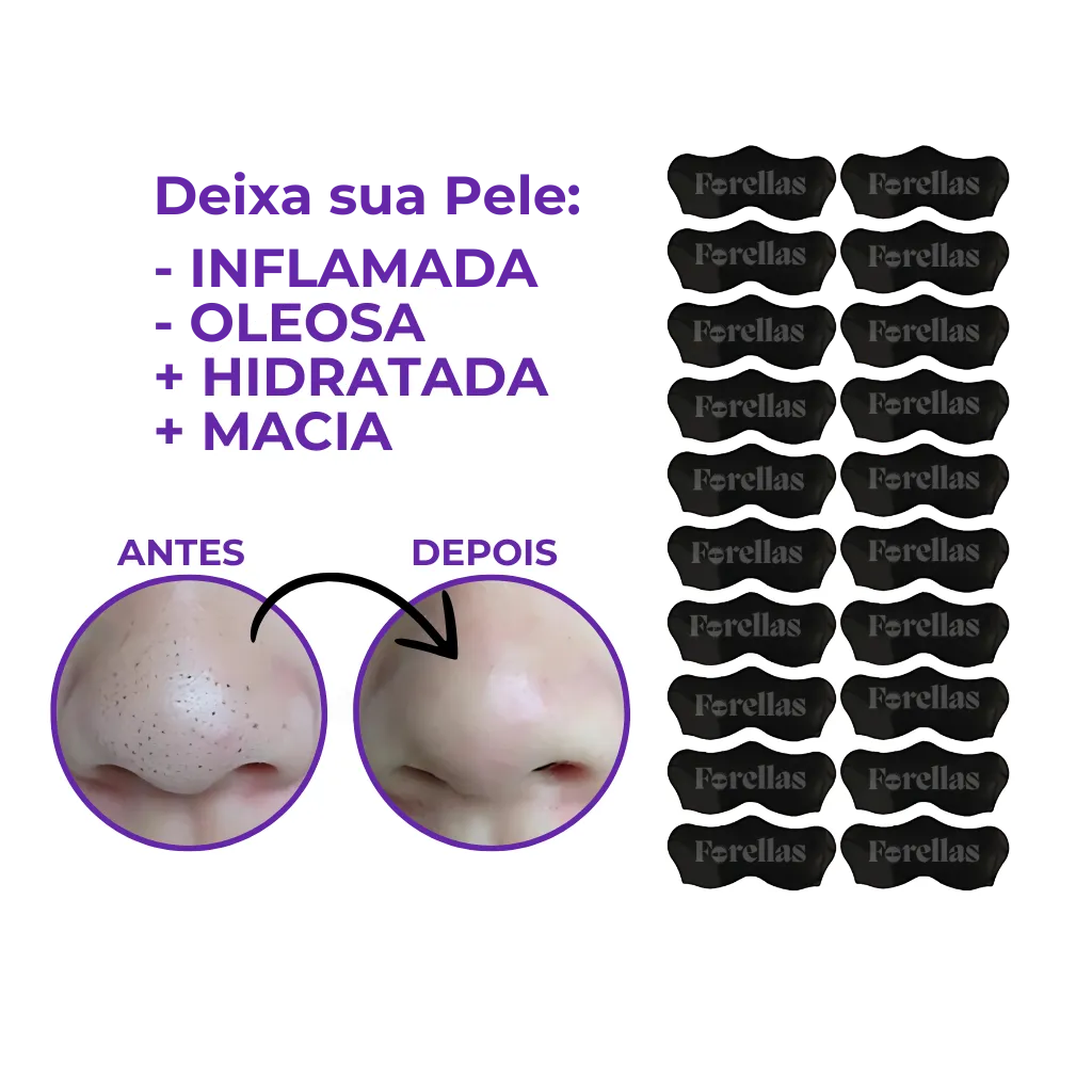 Blackhead Mask - Eliminate Blackheads from Your Nose Painlessly! 